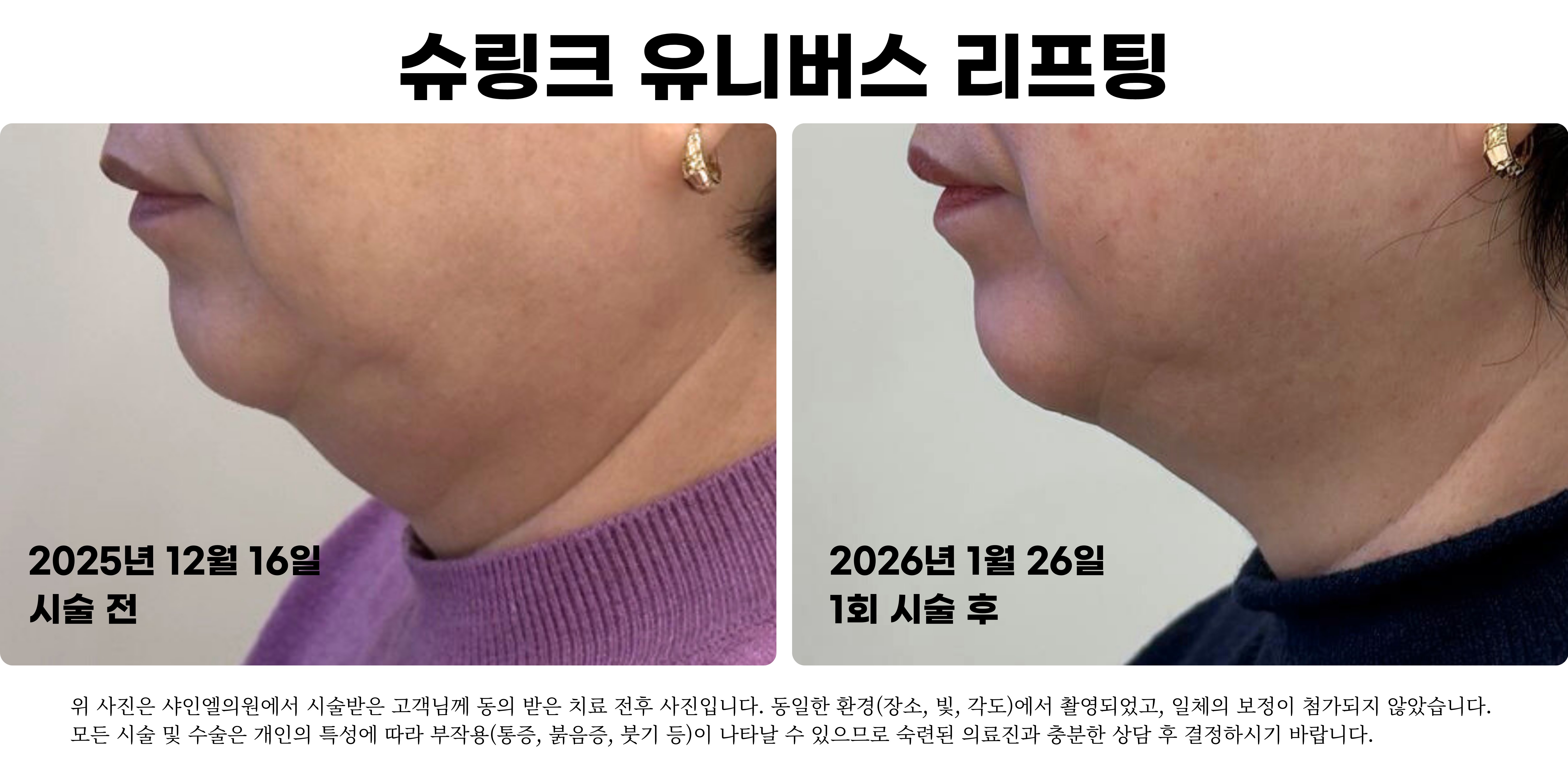 범계 슈링크 유니버스 리프팅 1회 시술 전 1개월 후 전후사진 샤인엘의원