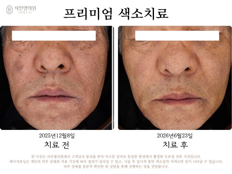 범계 피부과 레이저토닝 기미 잡티 흑자 색소치료 전후사진 샤인엘의원